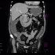 Tumor of cecum, enterography: CT - Computed tomography